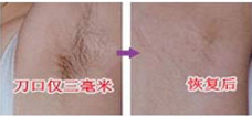 腋臭手术对比图